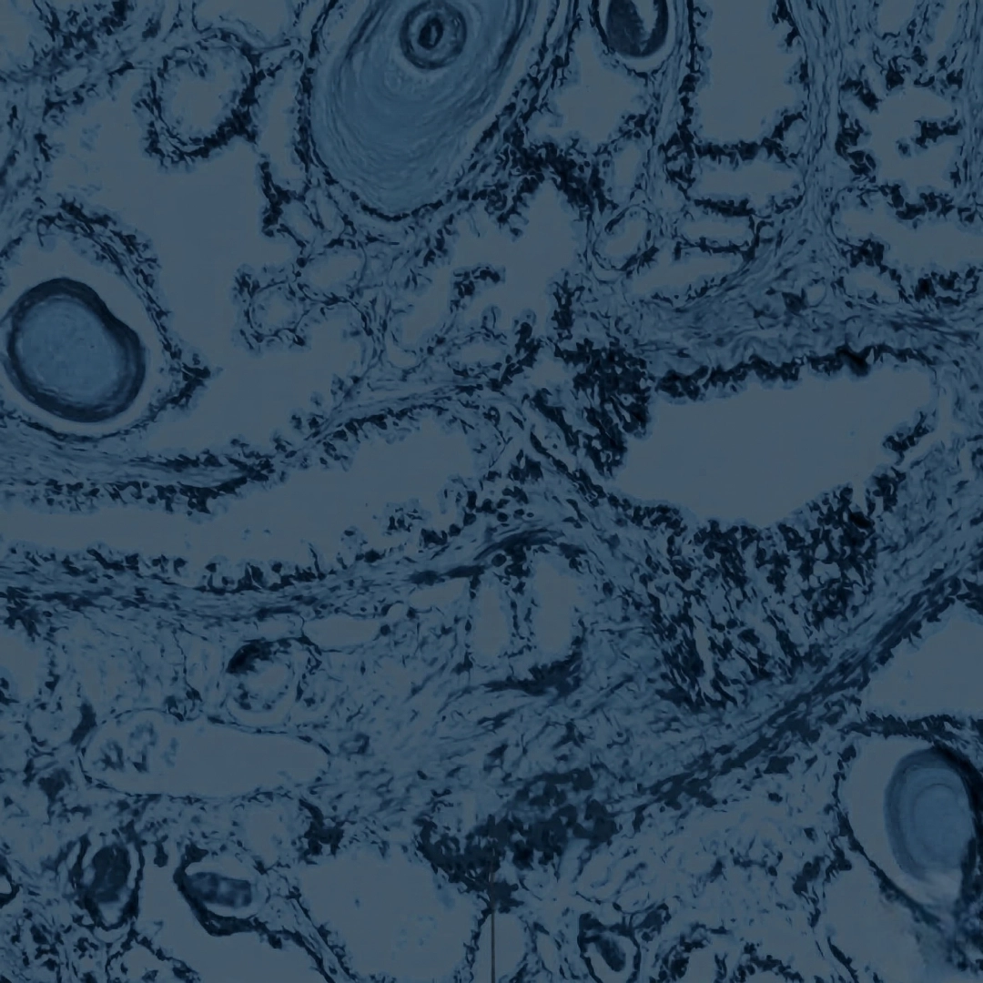 만성전립선염,<br>만성골반통증