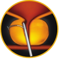 유로리프트 시술과정 03