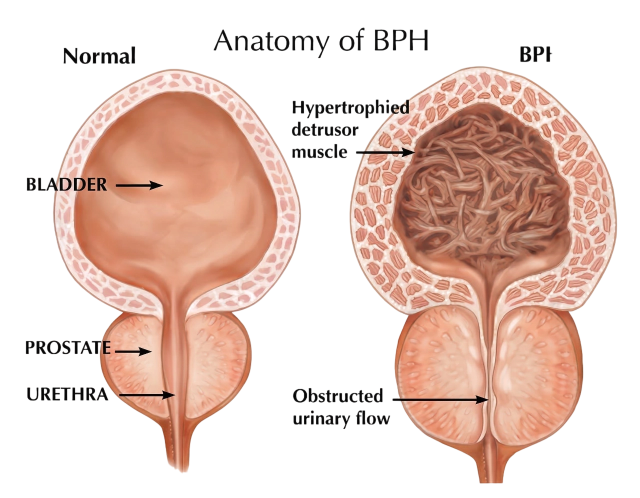 전립선비대증 구조 설명 이미지