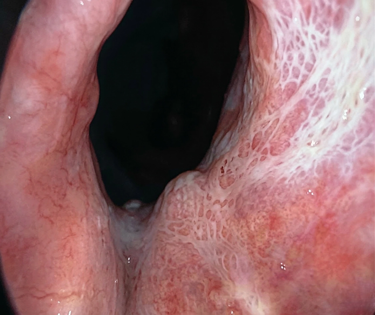 전립선 비대증 과정 04